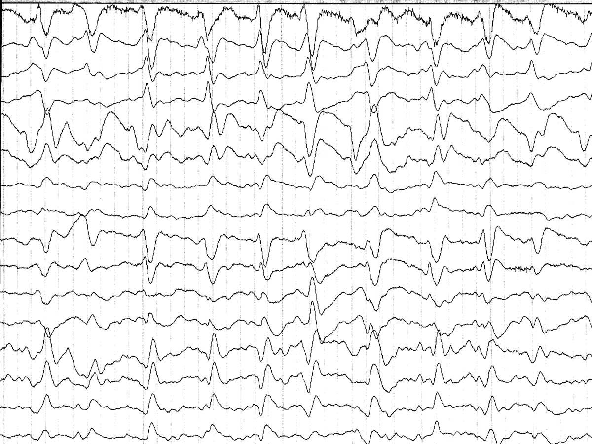Electroencefalograma